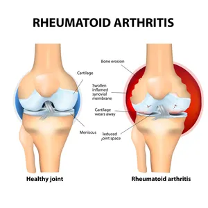 Nueva Crema para artritis reumatoide, crema para aliviar el dolor <span class=keywords><strong>de</strong></span> rodilla y cuello, espondilosis Cervical, dolor muscular, ungüento para reumatismo - Product Image 4