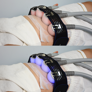 Appareil d'analyse de la peau du visage et du corps par IA, équipement esthétique de cryo-lifting thermique à froid à 5 poignées - Product Image 3