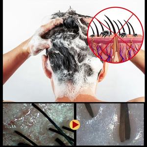 Couro cabeludo Psoríase Tratamento Shampoo Dermatite seborreica Foliculite Caspa Seco Coceira Scalp Hair Wash - Product Image 6