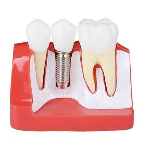 Modèle d'implant dentaire Dt M2017R, modèle anatomique en silicone médical pour l'enseignement des sciences médicales - Product Image 3