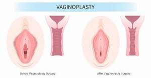 Équipement de beauté médicale, machine de resserrement vaginal en gynécologie, laser diode 980 nm 1470 nm - Product Image 5