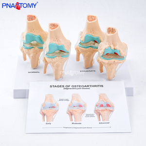 Modelo de Articulación de <span class=keywords><strong>Rodilla</strong></span> Humana de 4 Etapas con Osteoartritis Patológica, Herramienta Educativa para Profesores de Ciencias Anatómicas, Enseñanza Médica - Product Image 4