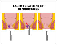 Dispositif de traitement des hémorroïdes au laser à diode de proctologie 980nm1470nm pour les hémorroïdes Fistule du sinus pilonidal Fissure au laser