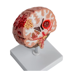 Modelo Anatómico de Cerebro de PVC HEALER, Patología de Hemorragia Cerebral y Malformación Arteriovenosa PNT - Product Image 1