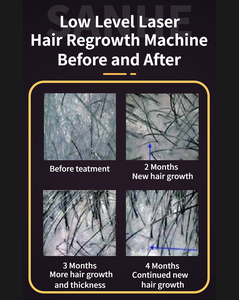 Terapi <span class=keywords><strong>Laser</strong></span> <span class=keywords><strong>Level</strong></span> rendah LLLT Diode 650nm pertumbuhan kembali perawatan rambut rontok dengan penganalisis rambut mesin penumbuh rambut <span class=keywords><strong>Laser</strong></span> tumbuh lebih cepat - Product Image 6