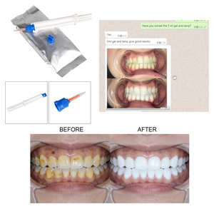 Kit Profesional de Blanqueamiento Dental para Consultorio, 35% HP, 16% de Peróxido de Hidrógeno, Sistema de Blanqueamiento Dental Fuerte para Spa - Product Image 6