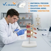 Modelo Anatómico Comparativo de Patología de Columna Vertebral, Modelo de Lesión de Vértebras Lumbares para Enseñanza de Ortopedia, CE/ISO/ROHS/CNAS