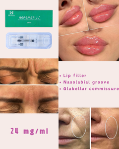 Prix surprise - 2 ml d'<span class=keywords><strong>acide</strong></span> <span class=keywords><strong>hyaluronique</strong></span> pour le remplissage des lèvres, augmentation des lèvres, <span class=keywords><strong>injection</strong></span> pour l'élargissement des lèvres - Product Image 4