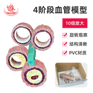 Modèle vasculaire, spécimen vasculaire pathologique en quatre étapes, démonstration de communication médecin-patient en cardiologie, vasculaire - Product Image 5