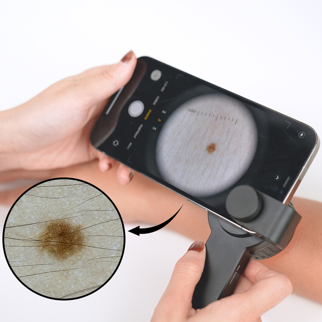 IBOOLO DE 3100 Dermatoscope Hand-held Imaging Device for Doctors to Examine Skin Hair Nails, Dermoscope