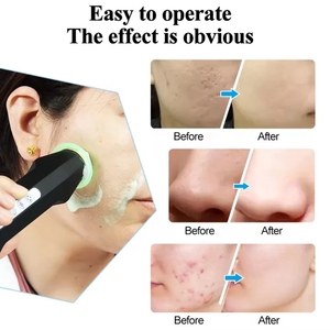 Stylo à bulles d'oxygène CO2 rechargeable, appareil de soin du visage au gel CO2, machine de beauté à bulles d'oxygène pour le visage, <span class=keywords><strong>SPA</strong></span> facial - Product Image 5