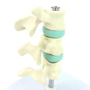 Osteoporose-Knochen modell-Zeigen Sie die normale/Osteopenie/osteoporo tische Knochen dichte mit abnehmbarem Wirbel - Product Image 6