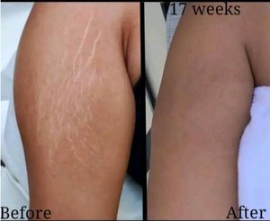 Nuevo Sistema de Láser de CO2 Fraccional de Alta Potencia con Tubo de RF para Reducción de Arrugas, Pigmentación, Estrías y Rejuvenecimiento de la Piel - Product Image 4