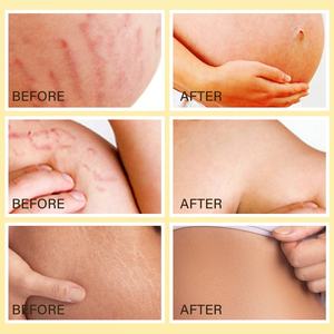 100% natürlicher Ursprung Dehnung streifen Präventions öl Hautpflege Stretch Mark Massage öl - Product Image 5
