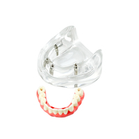 YOUYA DENTAL Nuevo Modelo de Implante Dental de Resina MX-089, 4 Implantes, Mandíbula Baja, Puente Maryland, Restauración de Sobredentadura, Tipodonto Educativo