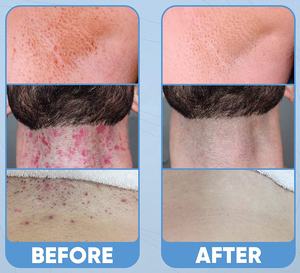 Traitement inhibiteur de cheveux incarnés correcteur de taches foncées après rasage réparation sérum Toner <span class=keywords><strong>Lotion</strong></span> - Product Image 4