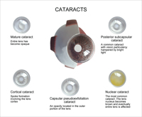Ojo médico humano agrandado, modelo de ojo de catarata, modelo anatómico de ojo, modelo de glaucoma