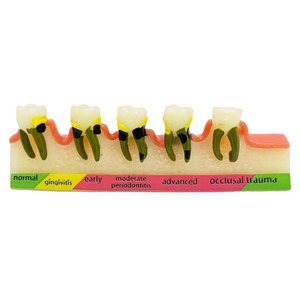 Medische Wetenschap Dummy Parodontitis Classificatie Tandheelkundig Model Voor Medische Schoolopleiding - Product Image 1