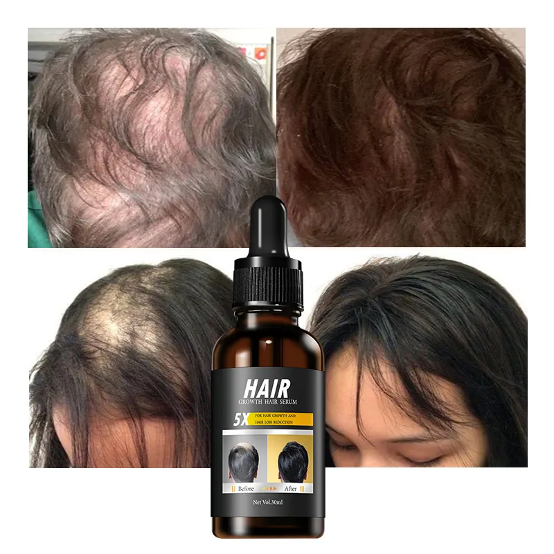 Sérum de repousse personnalisé pour le meilleur traitement capillaire, huile naturelle organique anti-chute, nourrit le cuir chevelu, sérum de croissance des cheveux