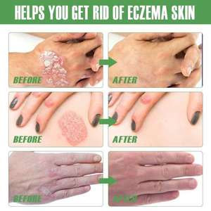 Spray Erboristico Biologico per Eczema, Psoriasi e Dermatite, Lenitivo ad Azione Rapida, Anti-Infiammatorio, Spray per la Cura della Pelle 30ml - Product Image 5