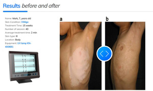 Equipo de Fototerapia Clínica UVB de Banda Estrecha de 311nm para Todo el Cuerpo, para Vitiligo, Psoriasis y Dermatitis Atópica - Product Image 3