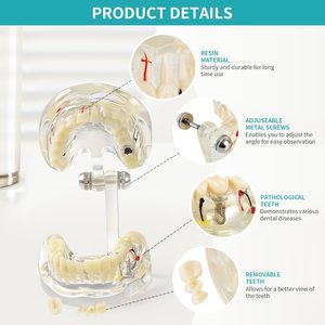 Modelo Dental Patológico Transparente con Dientes de Resina Removibles y Ángulo Ajustable para Enseñanza y Entrenamiento sobre Enfermedades - Product Image 6