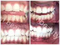 أفضل خيار الذهبي التحقق المورد الأسنان المحمول الكمال ابتسامة هلام دعم المهنية استخدام led ماكينة تبييض أسنان