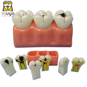 Chất lượng cao 4-lần nha khoa sâu răng phát triển mô hình giảng dạy nha khoa mô hình - Product Image 1