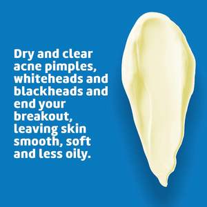 ครีมซัลเฟอร์ครีม Seye 2.6ออนซ์รักษา<span class=keywords><strong>สิว</strong></span>ด้วย<span class=keywords><strong>ฮอร์โมน</strong></span>ปลอดภัยและมีประสิทธิภาพครีมบำรุงจุดด่างดำทุกวัน10นาที - Product Image 4