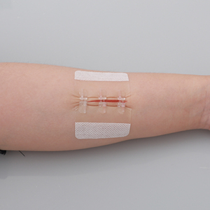 Dispositif de Fermeture de Plaie Sans Douleur à Fermeture Éclair, Kit de Bandes de Fermeture de Pansement Sans Suture, Fermetures d'Urgence pour Lacerations, Infrarouge Lointain - Product Image 1