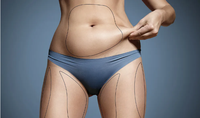Remplissage des fesses, lifting du visage, liposuccion par canule BBL, Endolaser 980nm pour la dissolution des graisses, élimination de la peau relâchée, anti-cellulite, élimination des rides 1470nm