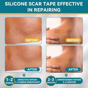 Bande adhésive en silicone pour cicatrices chirurgicales, couvre-cicatrices chéloïdes pour le visage, bandes post-césarienne, crème anti-rides, gel de nuit pour les lèvres, hydrocolloïde - Product Image 6