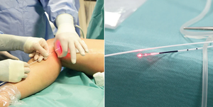 980 laser endovenoso EVLT 1470nm irradiazione endovenosa sangue varicosa vascolare ragno vena laser rimozione vene varicose dispositivo vene varicose - Product Image 5