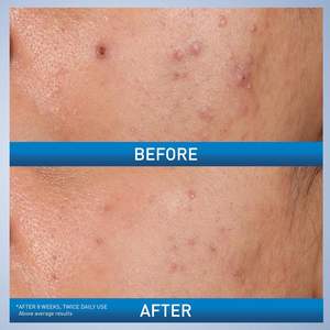 เจลควบคุมสิว2% กรดซาลิไซลิกสำหรับผิวหน้า1.35ผิวมัน - Product Image 5