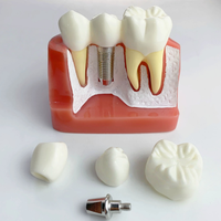 Modèle de démonstration d'implant dentaire Premium 4X avec couronne et pont amovibles pour cliniques et écoles dentaires