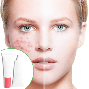 Crème anti-acné thaïlandaise pour hommes et femmes, éliminateur de cicatrices et de boutons avec niacinamide et acide salicylique, éliminateur d'acné du visage - Product Image 1