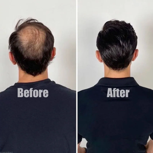 Prothèse capillaire Lace Front Mono Poly Skin pour hommes, en cheveux humains indiens, pour cheveux clairsemés - Product Image 6