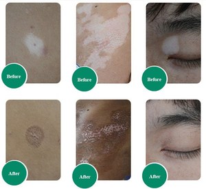 Gran oferta, lámpara de fototerapia médica Uvb 311nm, luz Uvb para vitiligo - Product Image 6