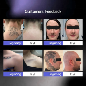 Système Pico multi-longueurs d'onde professionnel, 4 embouts <span class=keywords><strong>pour</strong></span> l'élimination des tatouages, la correction des sourcils, le raffinage des pores et l'éclaircissement, utilisation en salon - Product Image 5