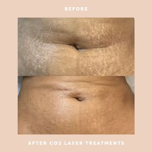 Système laser CO2 60W pour le rajeunissement de la peau Récupération des vergetures Resserrement vaginal Non invasif pour la santé intime des femmes - Product Image 5