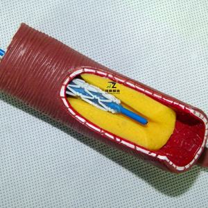 รูปแบบการสอนกระบวนการสาธิตการติดตั้งการใส่ท่อเลือดแบบขยายสำหรับหลอดเลือดของมนุษย์ - Product Image 4