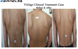 Thérapie par lumière UVB à bande étroite 311 nm, cabine de photothérapie UV pour le corps entier, pour le vitiligo, le psoriasis, l'eczéma - Product Image 5