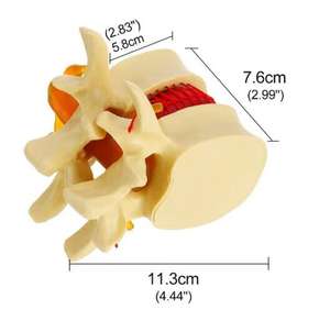 Lumbar Spine Model Intervertebral Disc Model Diseased Lumbar Spine Model - Product Image 1