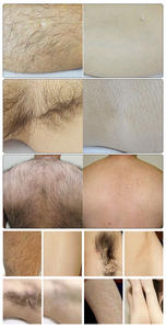 Depilación láser de diodo, dispositivo de belleza para blanquear la piel, rejuvenecimiento de la piel sin dolor de escritorio, máquina de depilación corporal con láser de diodo - Product Image 5