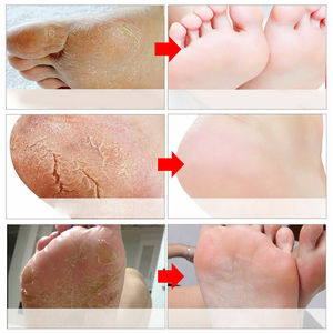 ZS exfoliant Peel Off <span class=keywords><strong>pied</strong></span> <span class=keywords><strong>masque</strong></span> enlever dur peau morte callosités pédicure chaussettes pieds Peeling <span class=keywords><strong>masque</strong></span> réparations talons fissurés peau rugueuse - Product Image 6