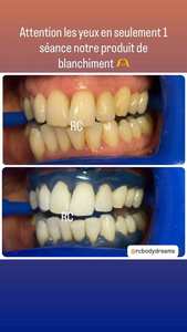 Professional Dental Grade 100% Good Result 5ml Big Size 44% <strong>Hydrogen</strong> <strong>Peroxide</strong> Dual Syringe <strong>Teeth</strong> <strong>Whitening</strong> <strong>Gel</strong> with Catalyst - Product Image 4