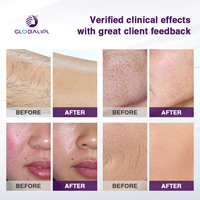 Máquina IPL de Luz de Banda Ancha NIR BBL Hero, Equipo Profesional de Depilación y Fotofacial, Certificado CE MDR