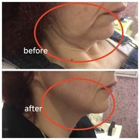 Chirurgie plastique, lifting du visage par endolaser, canule Endoface, remplissage des fesses BBL, laser diode 980 1470nm, lipolyse, liposuccion
