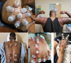 Ventouses de massage incurvées de 4,4 cm en PS, résistantes à la corrosion, à <span class=keywords><strong>prix</strong></span> d'usine, pour thérapie par ventouses chinoises à aspiration sous vide - Product Image 4