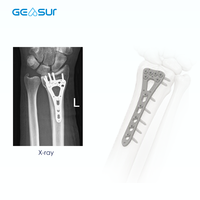 Plaques de fixation orthopédiques à angle variable en titane, approuvées CE, pour le soutien du radius distal, implant traumatique orthopédique.